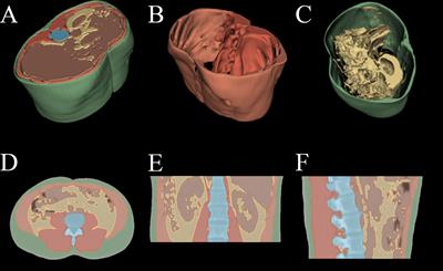 Fully automated 3D body composition analysis and its association with overall survival in head and neck squamous cell carcinoma patients